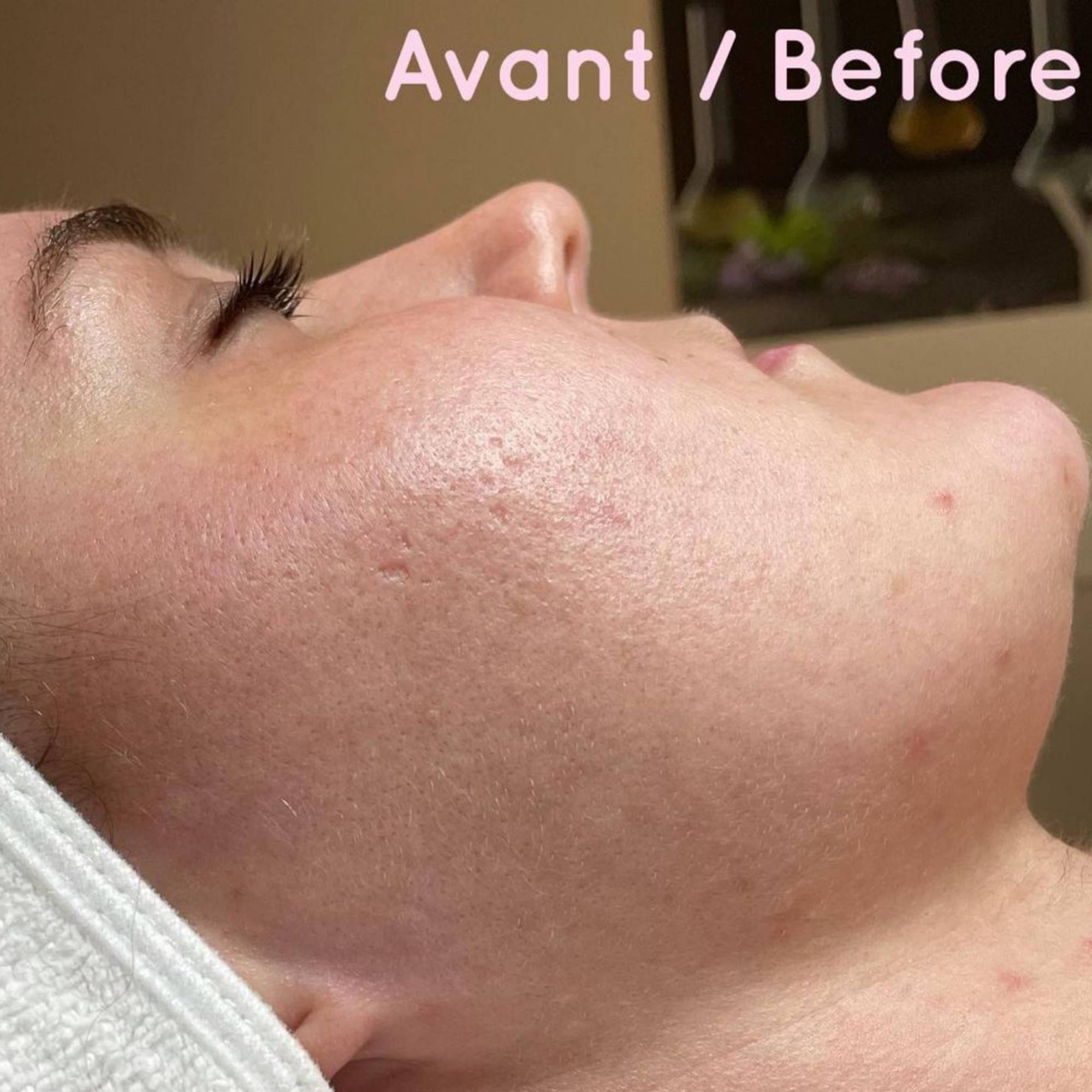 Alpha-Peel